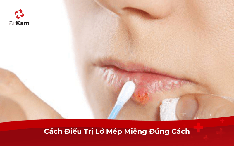 Cách Điều Trị Lở Mép Miệng Đúng Cách