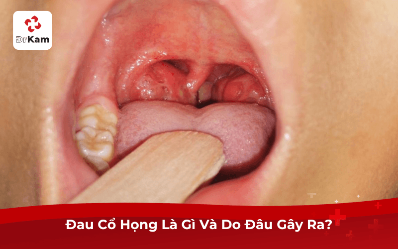 Đau Cổ Họng Là Gì Và Do Đâu Gây Ra?