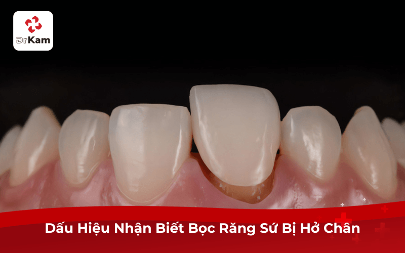 Dấu Hiệu Nhận Biết Bọc Răng Sứ Bị Hở Chân