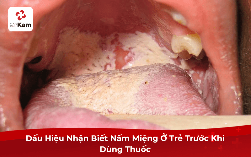 Dấu Hiệu Nhận Biết Nấm Miệng Ở Trẻ Trước Khi Dùng Thuốc