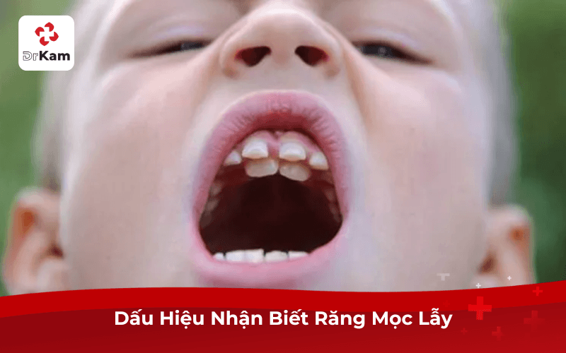 Dấu Hiệu Nhận Biết Răng Mọc Lẫy