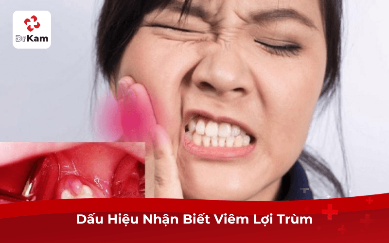 Dấu Hiệu Nhận Biết Viêm Lợi Trùm