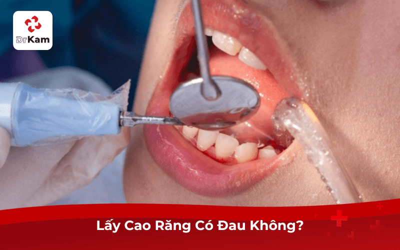 Lấy Cao Răng Có Đau Không?
