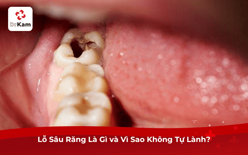 Lỗ Sâu Răng Là Gì và Vì Sao Không Tự Lành?