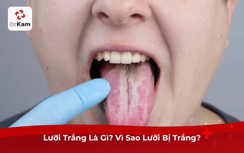 Lưỡi Trắng Là Gì? Vì Sao Lưỡi Bị Trắng?