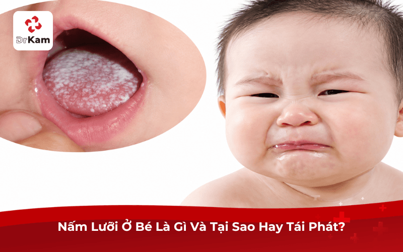 Nấm Lưỡi Ở Bé Là Gì Và Tại Sao Hay Tái Phát?