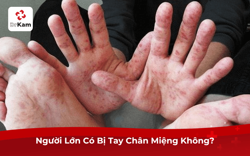 Người Lớn Có Bị Tay Chân Miệng Không?