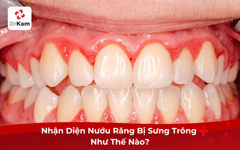 Nhận Diện Nướu Răng Bị Sưng Trông Như Thế Nào?