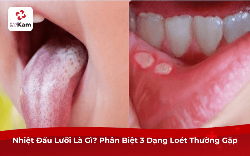 Nhiệt Đầu Lưỡi Là Gì? Phân Biệt 3 Dạng Loét Thường Gặp