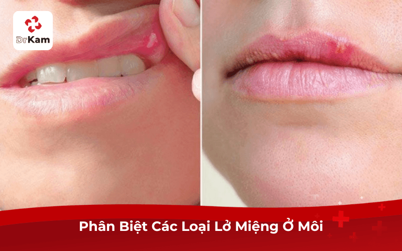 Phân Biệt Các Loại Lở Miệng Ở Môi