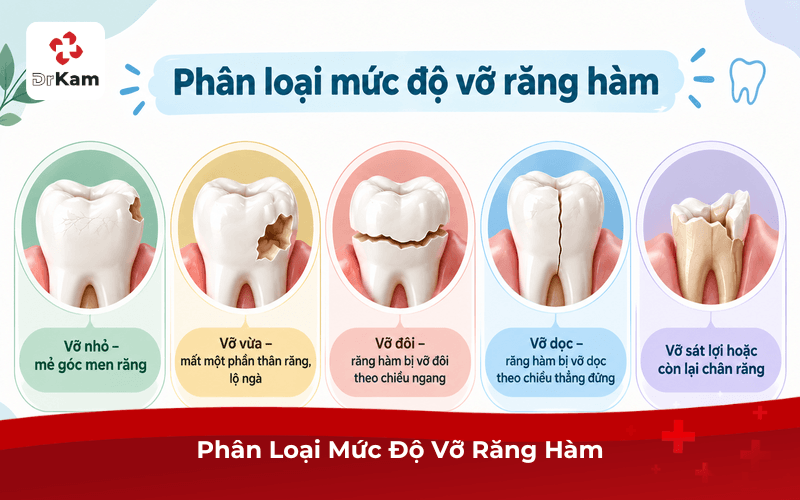 Phân Loại Mức Độ Vỡ Răng Hàm