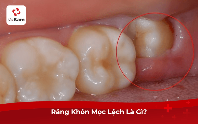 Răng Khôn Mọc Lệch Là Gì?