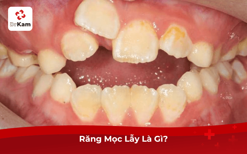 Răng Mọc Lẫy Là Gì?