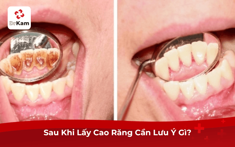 Sau Khi Lấy Cao Răng Cần Lưu Ý Gì?