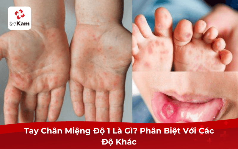 Tay Chân Miệng Độ 1 Là Gì? Phân Biệt Với Các Độ Khác