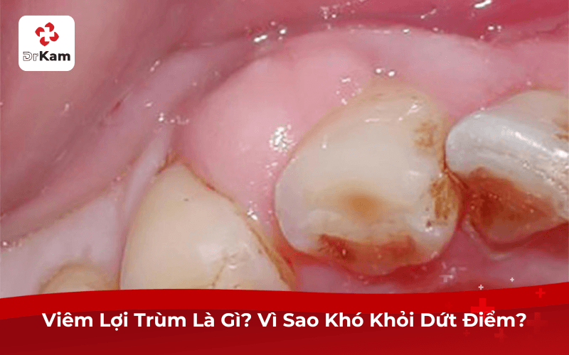Viêm Lợi Trùm Là Gì? Vì Sao Khó Khỏi Dứt Điểm?