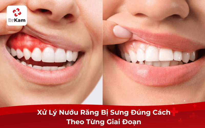 Xử Lý Nướu Răng Bị Sưng Đúng Cách Theo Từng Giai Đoạn